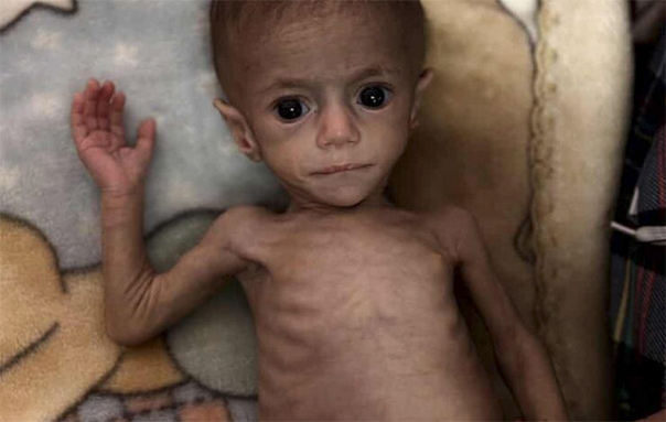 Verhungerndes Kind im Gazastreifen Juli 2025